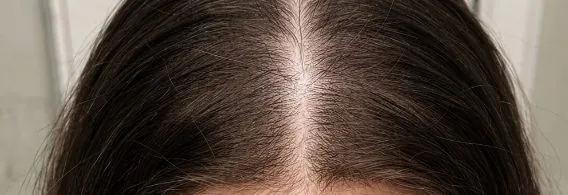 Two sprays to the scalp, morning and night. Ten seconds