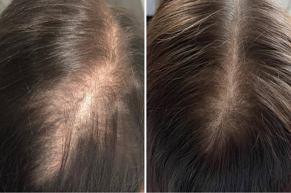 Karen S., 55 — crown, before and after 90 days Karen S., 55 — crown, before and after 90 days