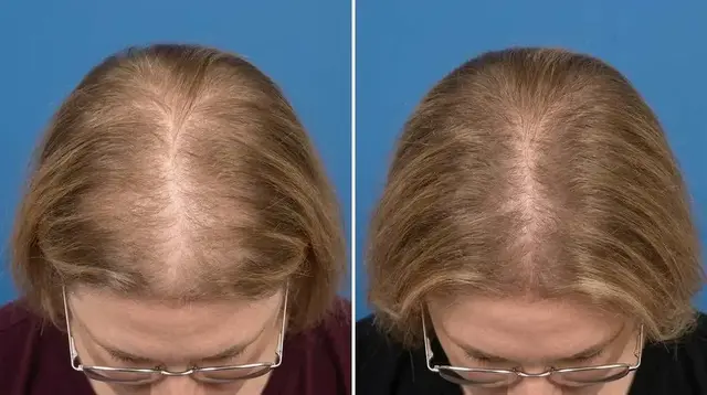 Marilyn T., 62 — part line, before and after 90 days Marilyn T., 62 — part line, before and after 90 days